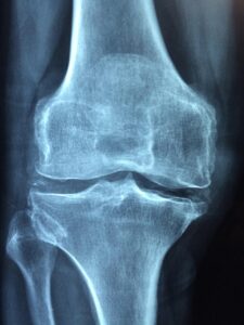 インソールを使った膝痛の予防方法とは？