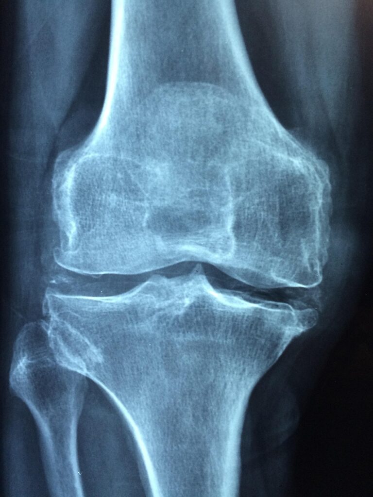 インソールを使った膝痛の予防方法とは？