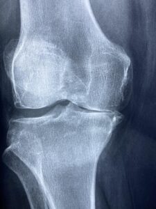 ACL断裂の診断方法はこれで決まり？あなたの疑問にお答えします！