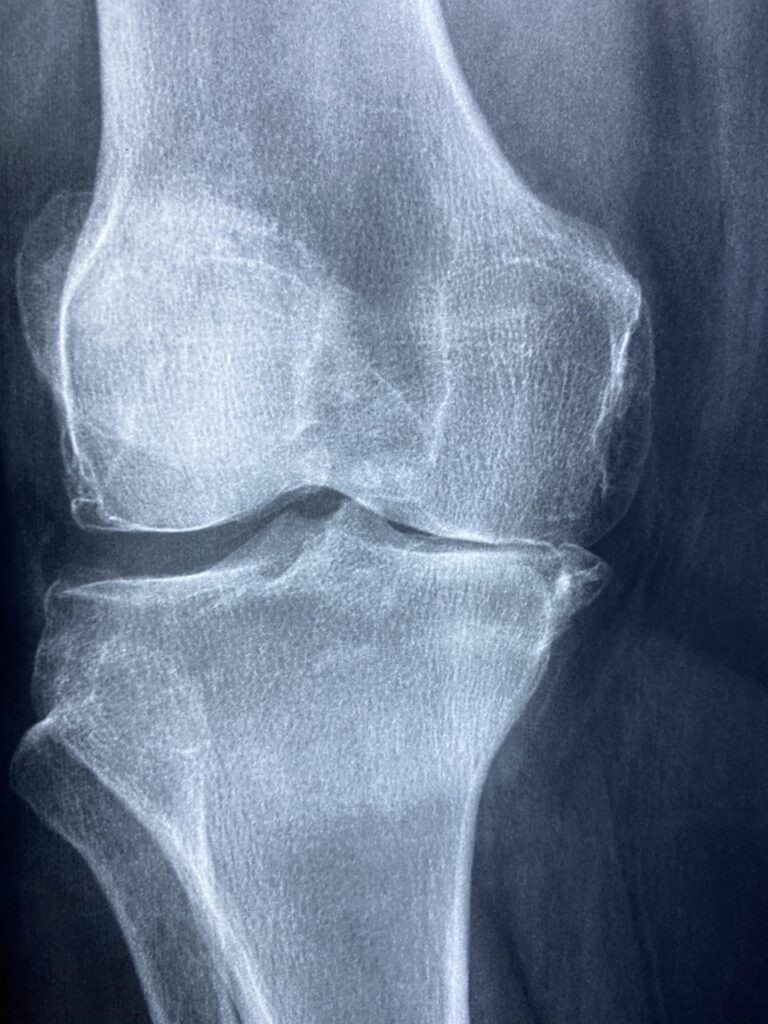 ACL断裂の診断方法はこれで決まり？あなたの疑問にお答えします！